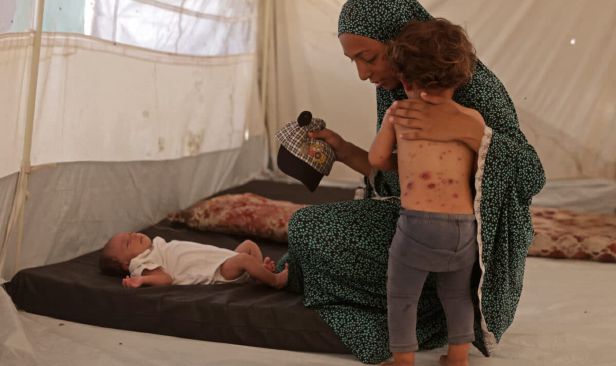 Cacar air menular di kem pelarian Gaza, ribuan kanak-kanak dijangkiti
